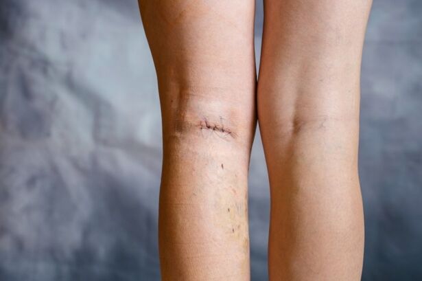 suture of the leg after varicose vein surgery