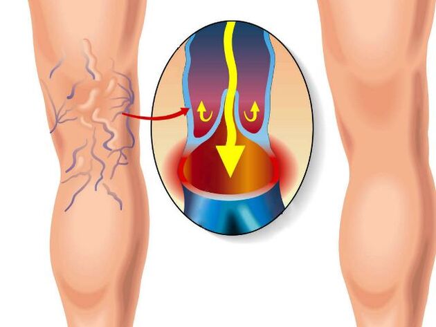 healthy leg and varicose veins of the leg