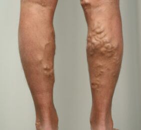 nodes of the legs with varicose veins