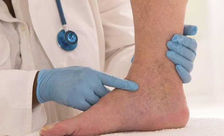 the doctor examines the legs with varicose veins