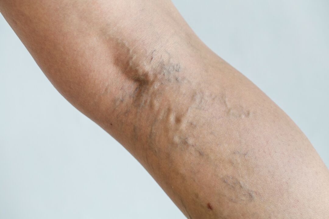 varicose veins of the leg photo 1