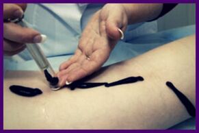 Procedure for the treatment of varicose veins with leeches (hirudotherapy)
