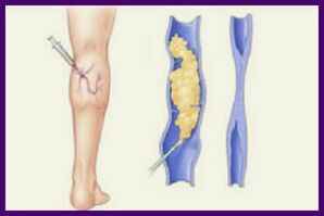 Sclerotherapy is a popular method for removing varicose veins in the legs