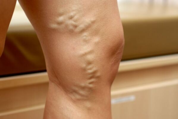 varicose veins of the legs with varicose veins of the pelvis
