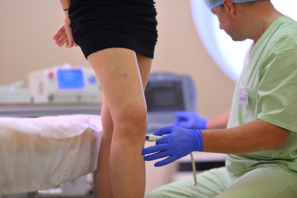 treatment of varicose veins of the legs