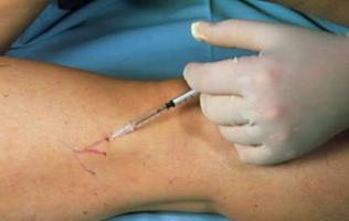 how varicose veins in the legs,