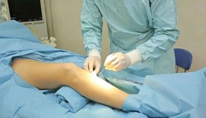 how to perform surgery for varicose veins