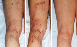 symptoms of varicose veins of the legs