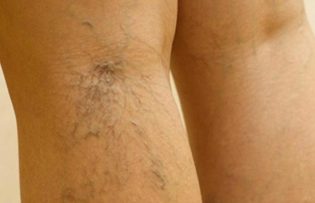 varicose veins in the legs,