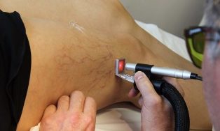 varicose laser treatment