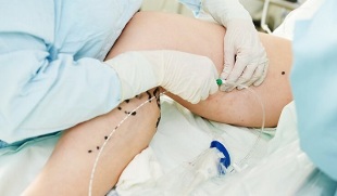 methods for treating varicose veins in the legs in women