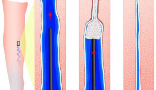 During sclerotherapy sclerosante input
